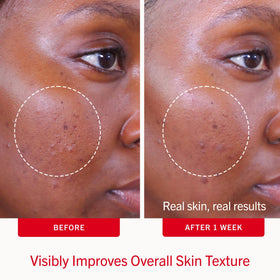 First Aid Beauty visual of salicylic acid concept emphasizing acne-fighting benefit