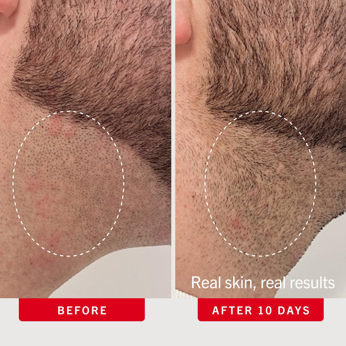 First Aid Beauty pad used on bikini line to help prevent ingrown hairs