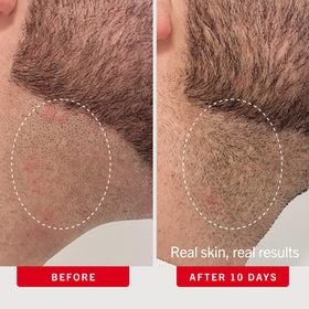 First Aid Beauty pad used on bikini line to help prevent ingrown hairs