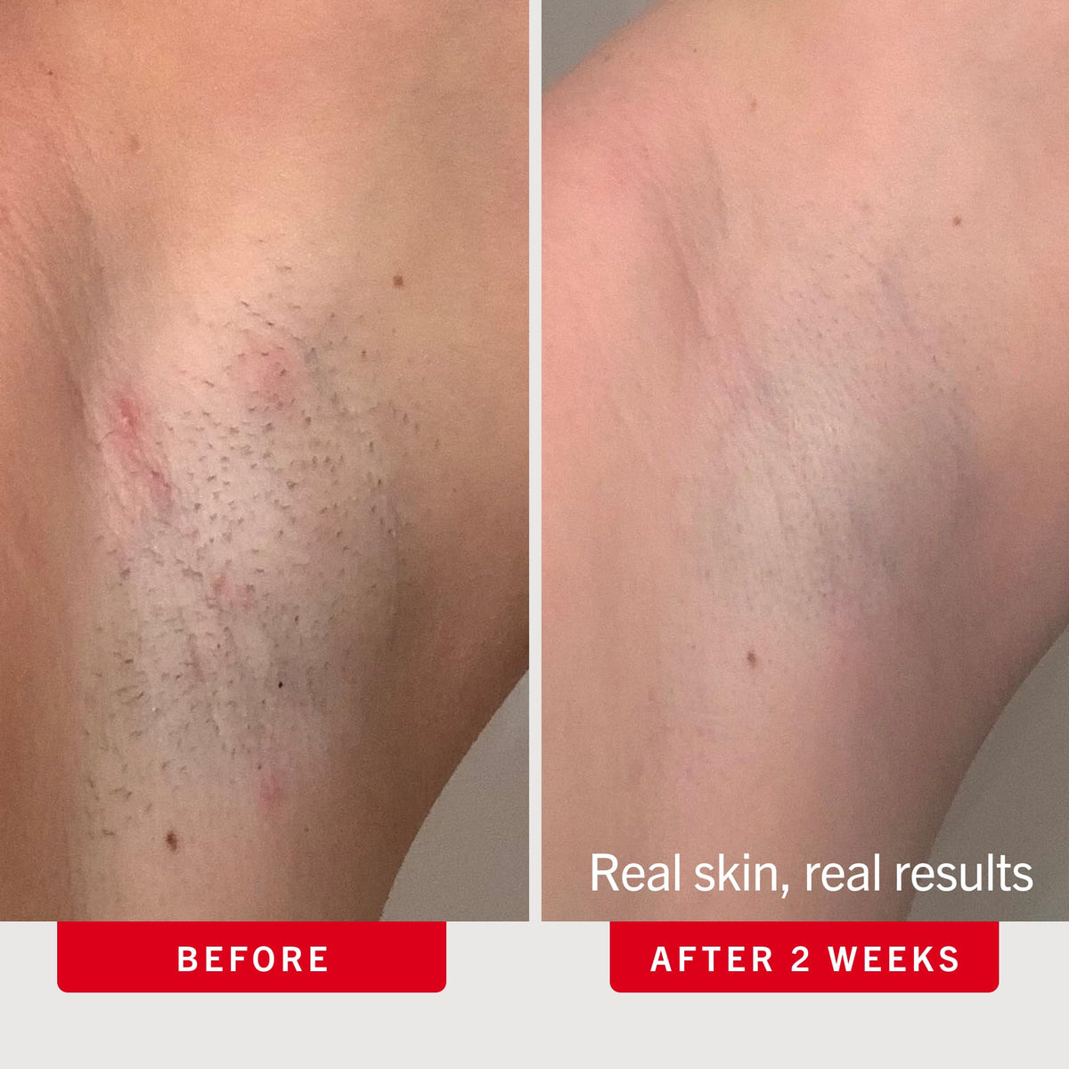 First Aid Beauty pad being applied to underarm to reduce razor bumps