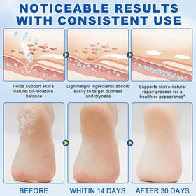 FlameBeauty before and after heel comparison showing visible skin improvement