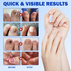 flasture skin-toned patch on toe illustrating discreet daytime appearance