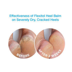 Flexitol tube in hand for scale showing portable foot treatment