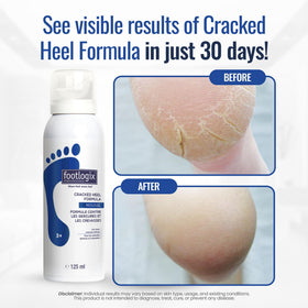 FOOTLOGIX application on heel in hand demonstrating targeted care