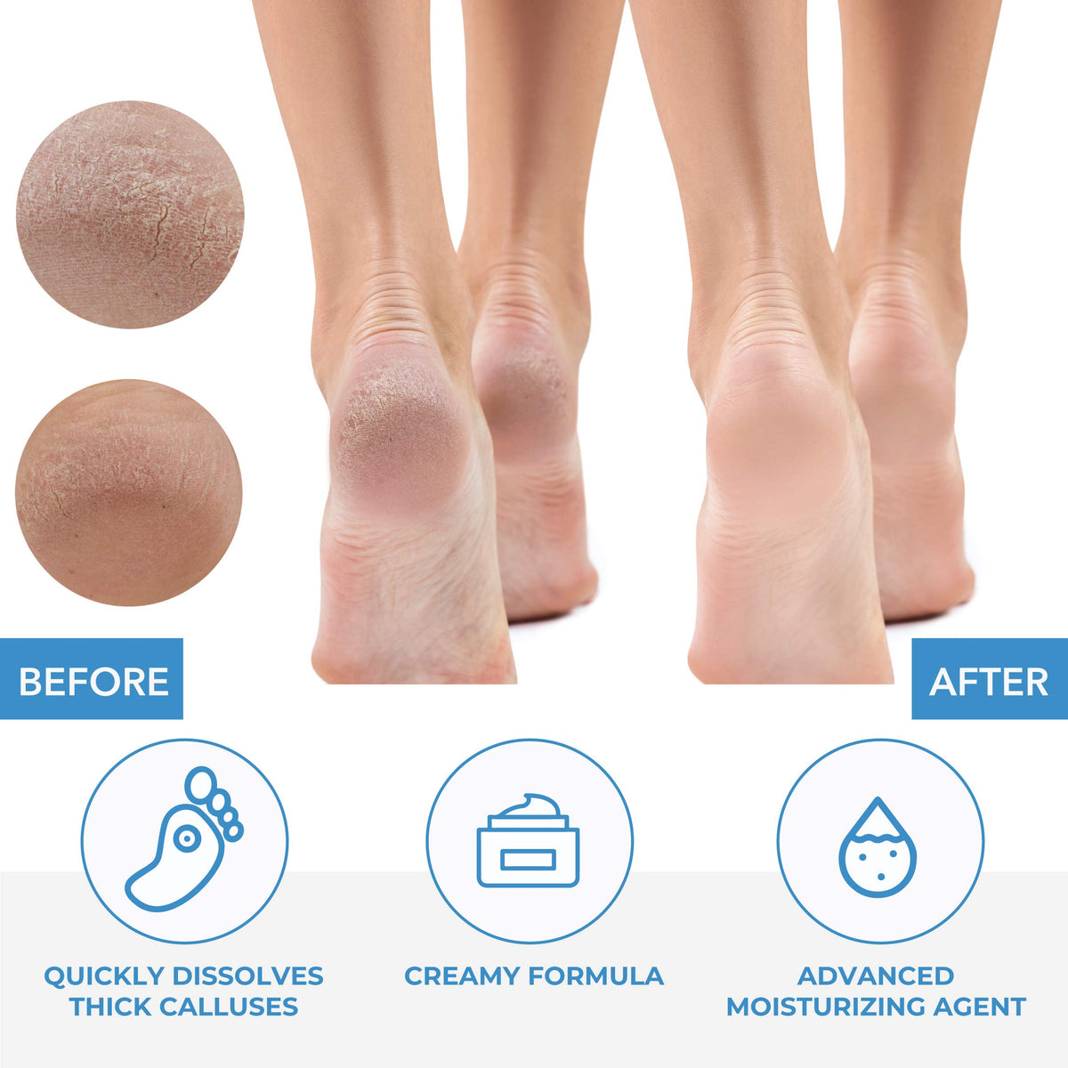 ForPro applied to foot demonstrating softening action for faster removal