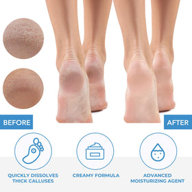 ForPro applied to foot demonstrating softening action for faster removal