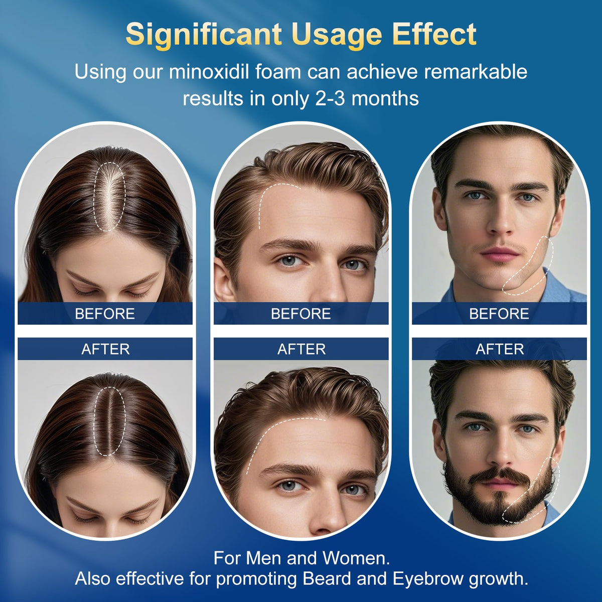 Applying Frnoip foam to scalp demonstrating targeted coverage