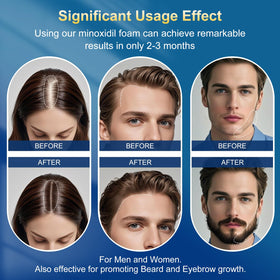 Applying Frnoip foam to scalp demonstrating targeted coverage
