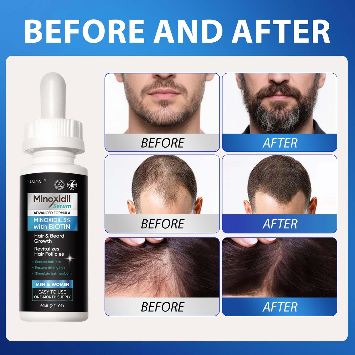 FUZYAT applied to scalp demonstrating even coverage and easy use benefit