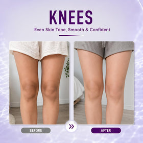Ganrek used on knees and elbows to reduce dark spots
