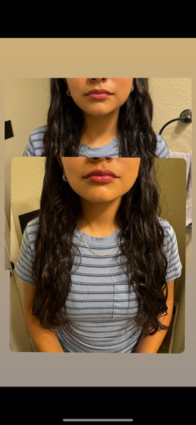 Generic before and after lips comparison showing fuller plumped result benefit