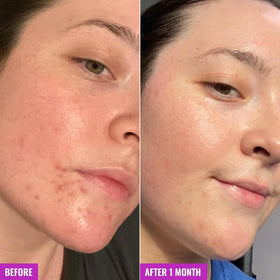 Good Molecules bar being used on back to target body acne and clogged pores