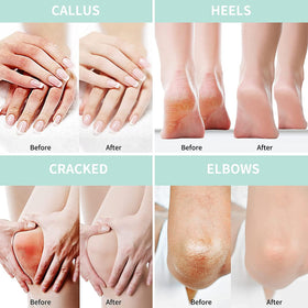 Grocerism application on heel demonstrating targeted use to soften calluses effectively