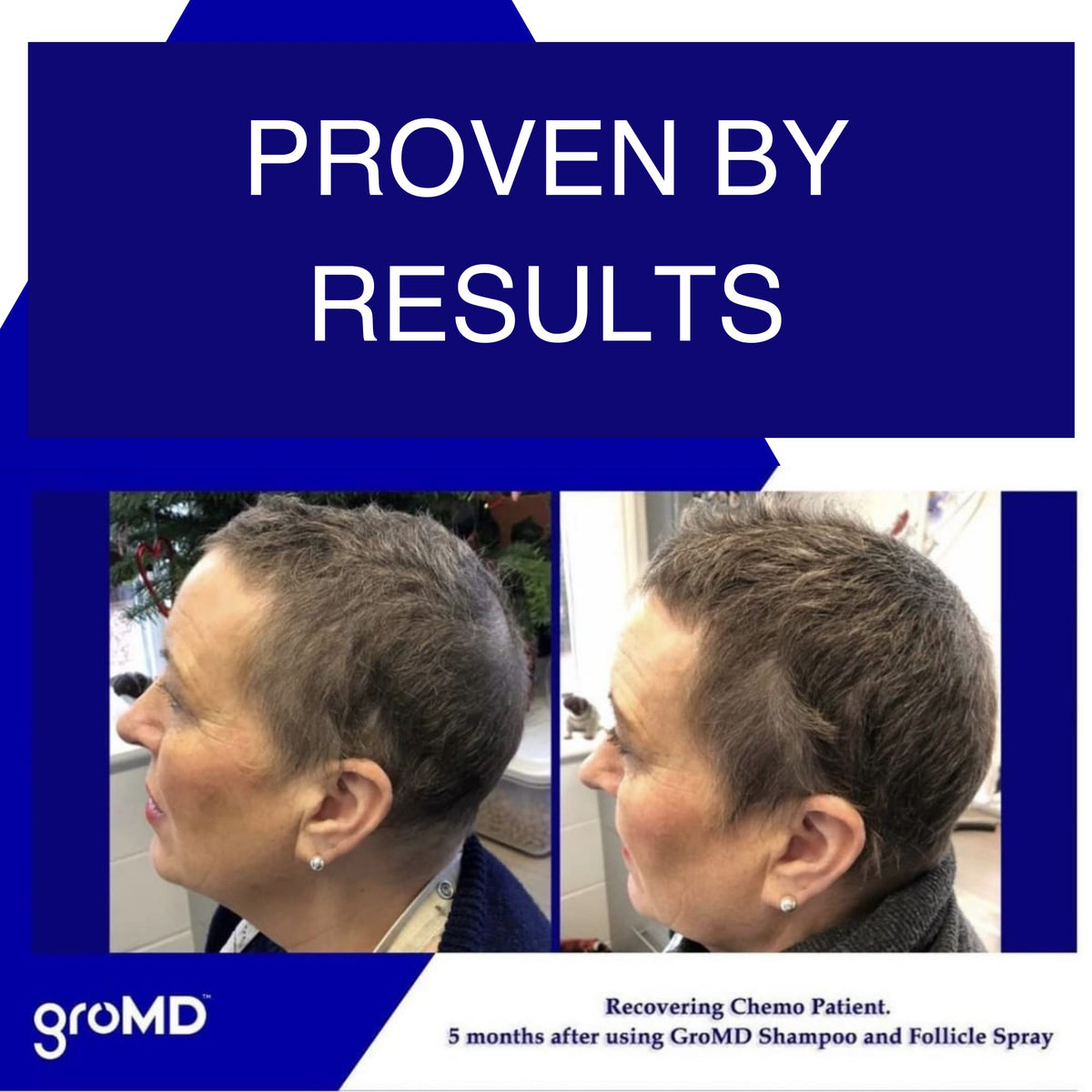 GroMD back label with ingredients and directions, helping shoppers understand DHT-blocking formula