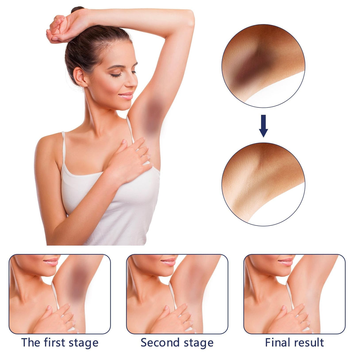 Gukei used on bikini line illustrating targeted dark spot care