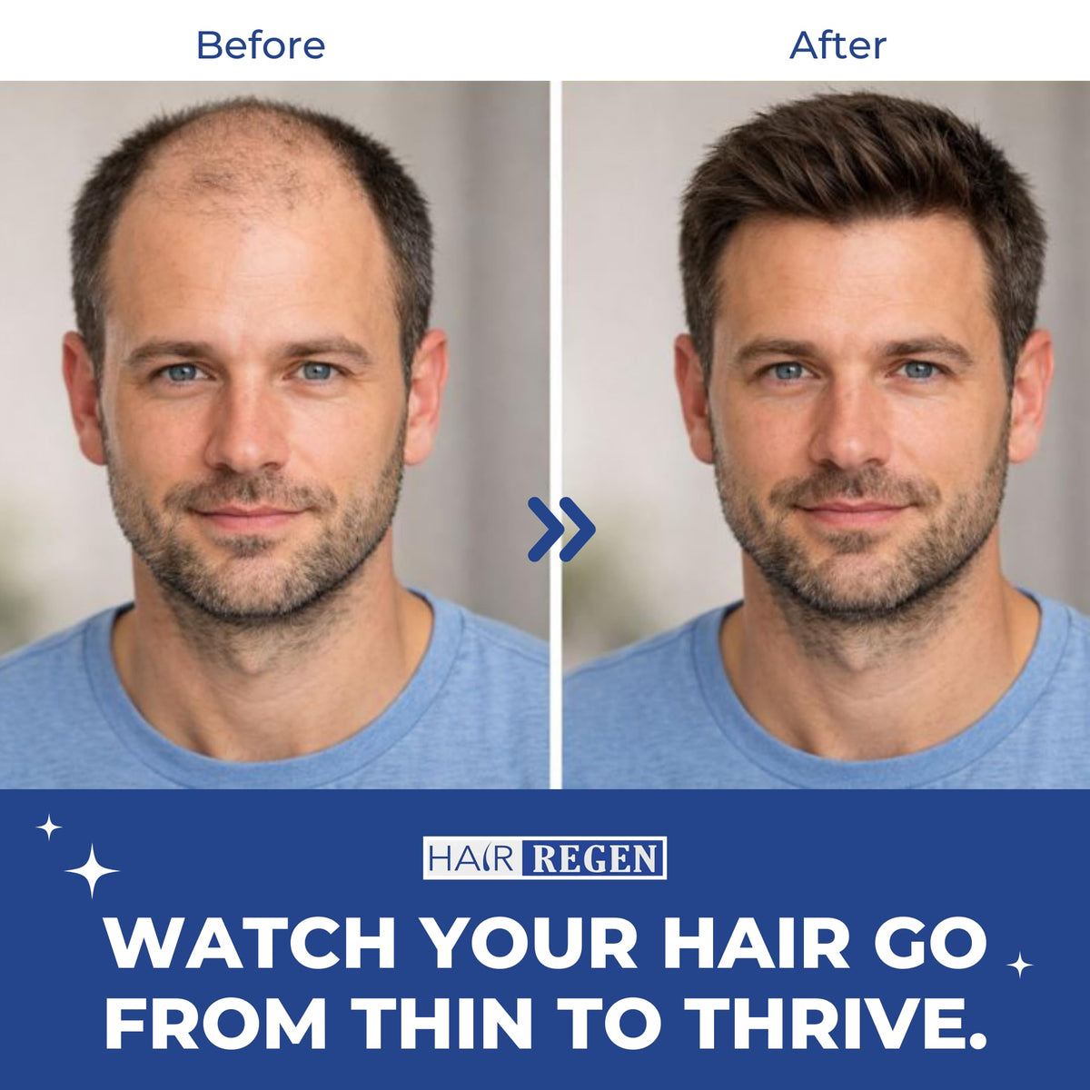 Hair Regen six bottles lined up indicating six-month supply