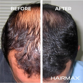 HairMax Ultima 12 in a bathroom lifestyle setting illustrating integration into daily routine
