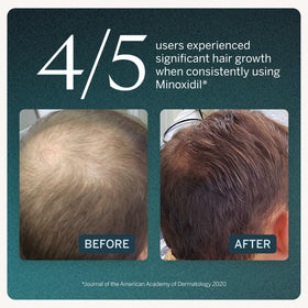 Happy Head dropper applying minoxidil to scalp demonstrating precise targeted use