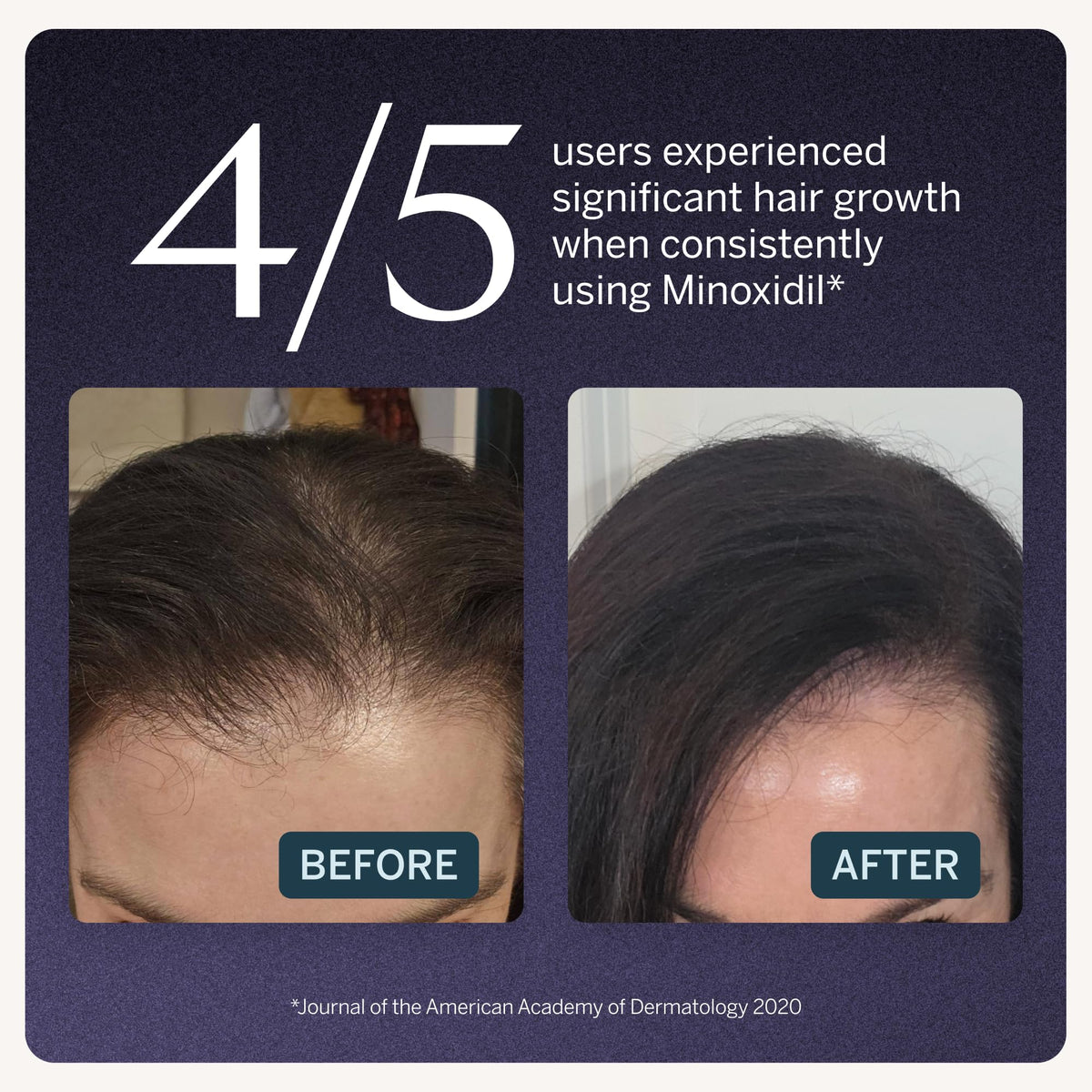 Happy Head dropper close-up applying precise drops to scalp for targeted coverage