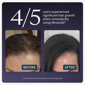 Happy Head dropper close-up applying precise drops to scalp for targeted coverage