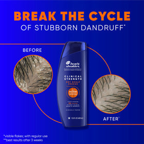 Application to scalp demonstrating Head & Shoulders helps target flakes and soothe irritation