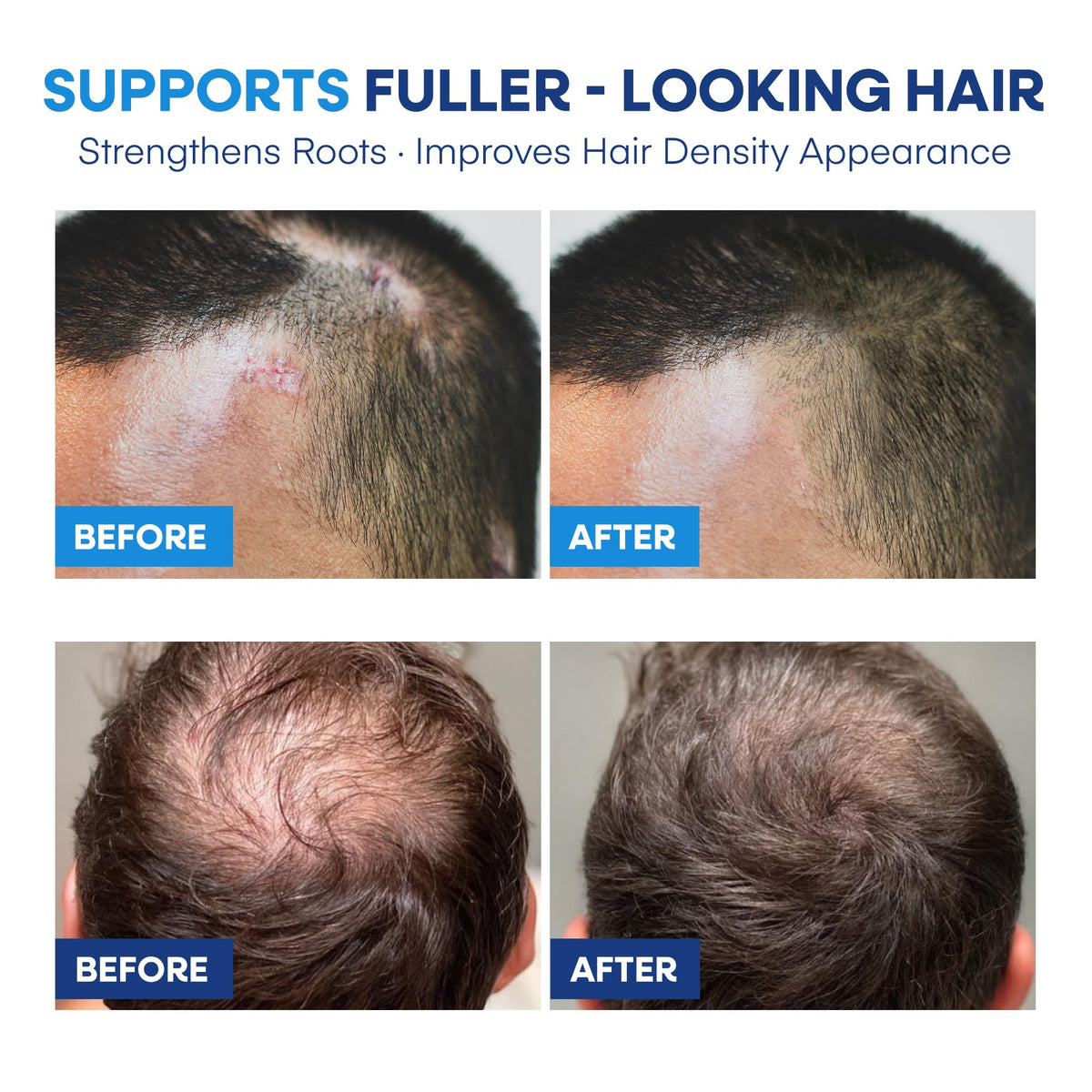 Hermon before and after scalp showing reduced visible flaking