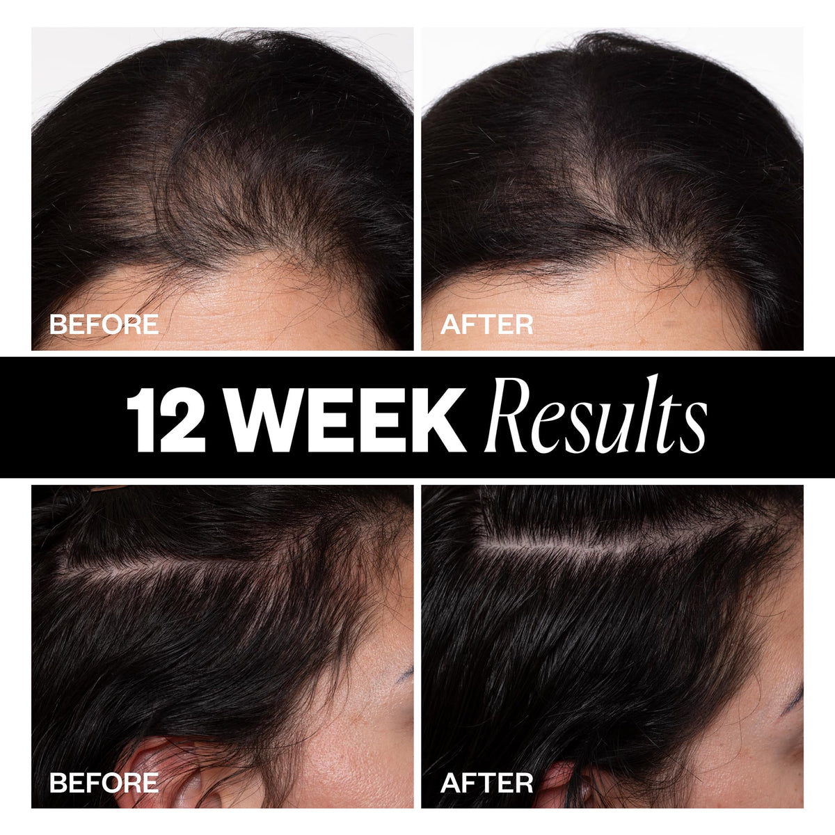 IGK applying mist to hairline demonstrating targeted thinning area treatment