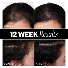 IGK applying mist to hairline demonstrating targeted thinning area treatment
