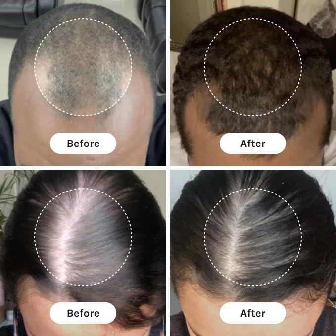 Applying InfiniWell serum to scalp for focused follicle support