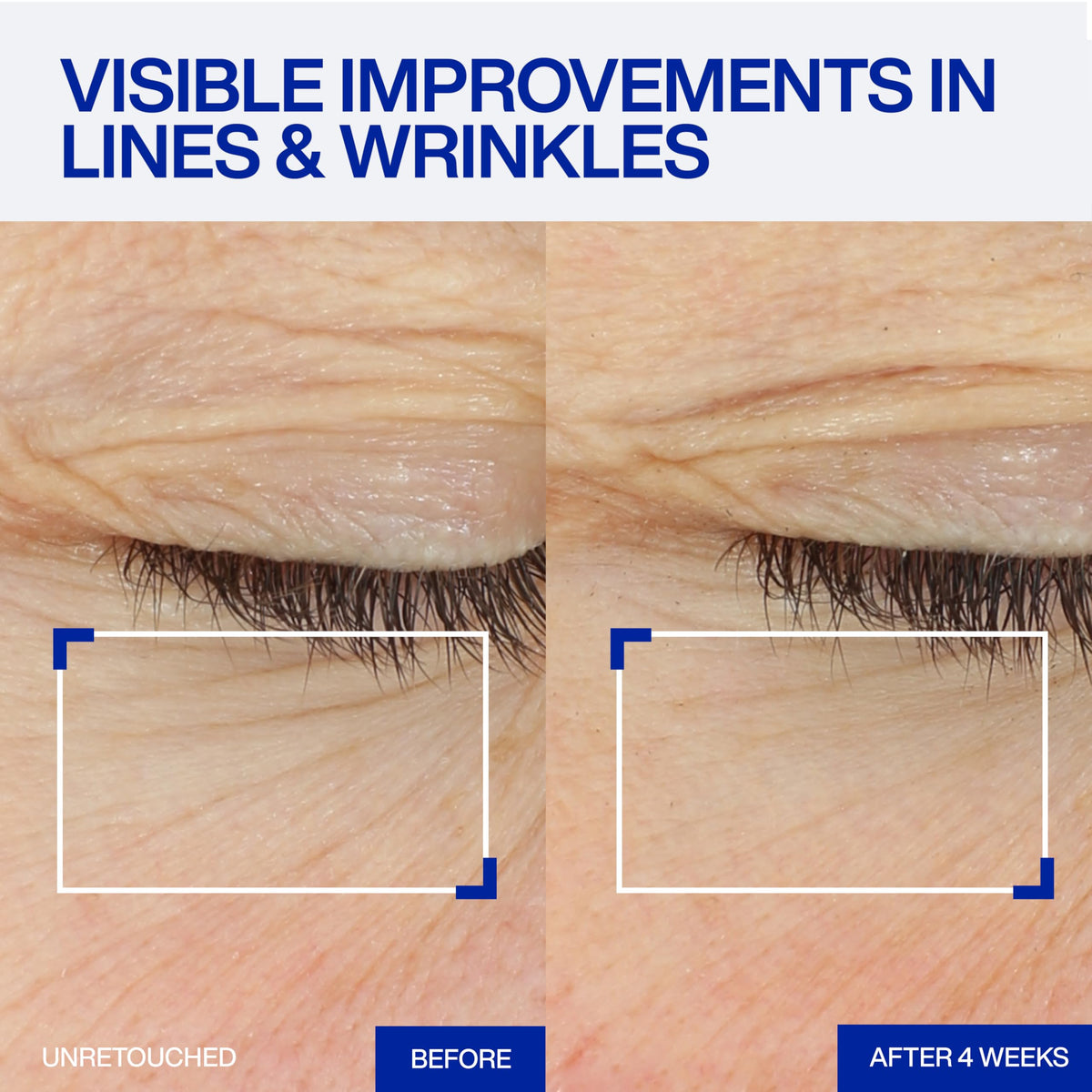 IOPE microscopic view of retinol-infused spicules highlighting targeted delivery advantage