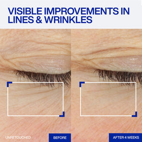 IOPE microscopic view of retinol-infused spicules highlighting targeted delivery advantage