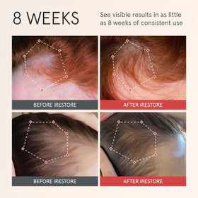 iRestore applying serum to scalp with dropper for targeted delivery