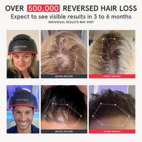 iRestore Elite side profile highlighting sleek curve and temple coverage benefit