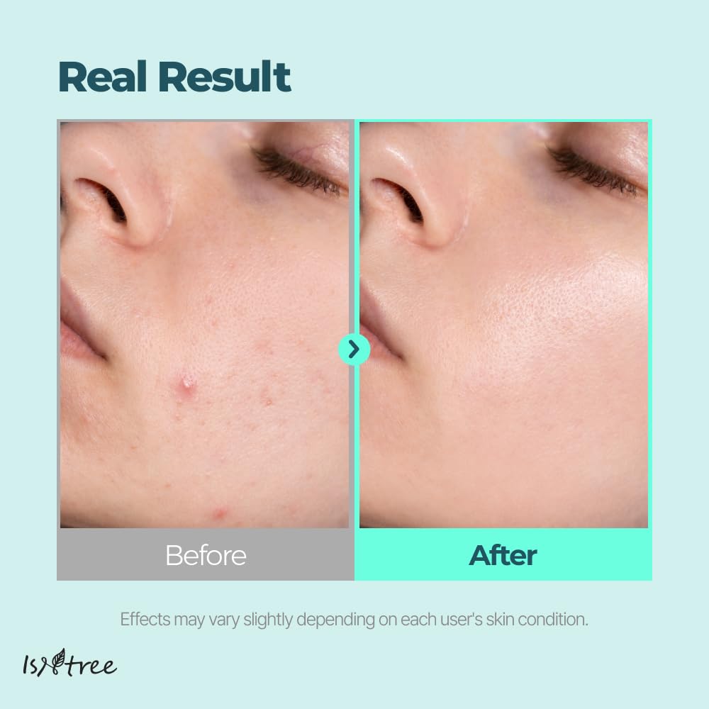 IsNtree mask as part of nighttime routine showing convenient final-step application