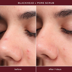 ITK blemish mist applied to back showing body acne control