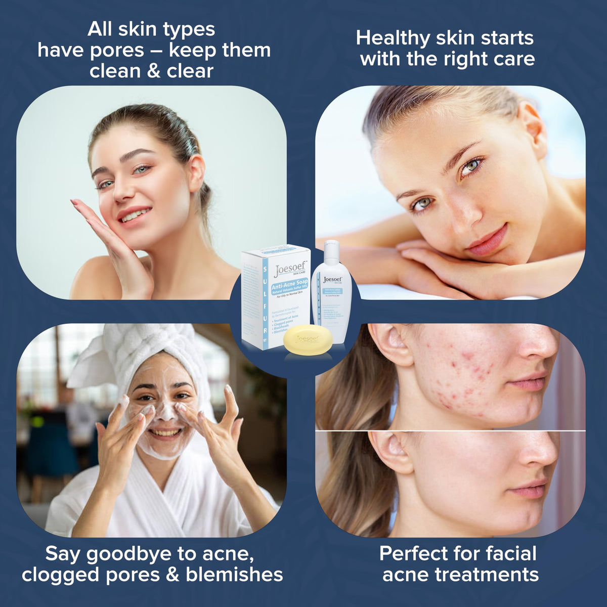 JOESOEF anti-acne lotion label visible for easy ingredient reference
