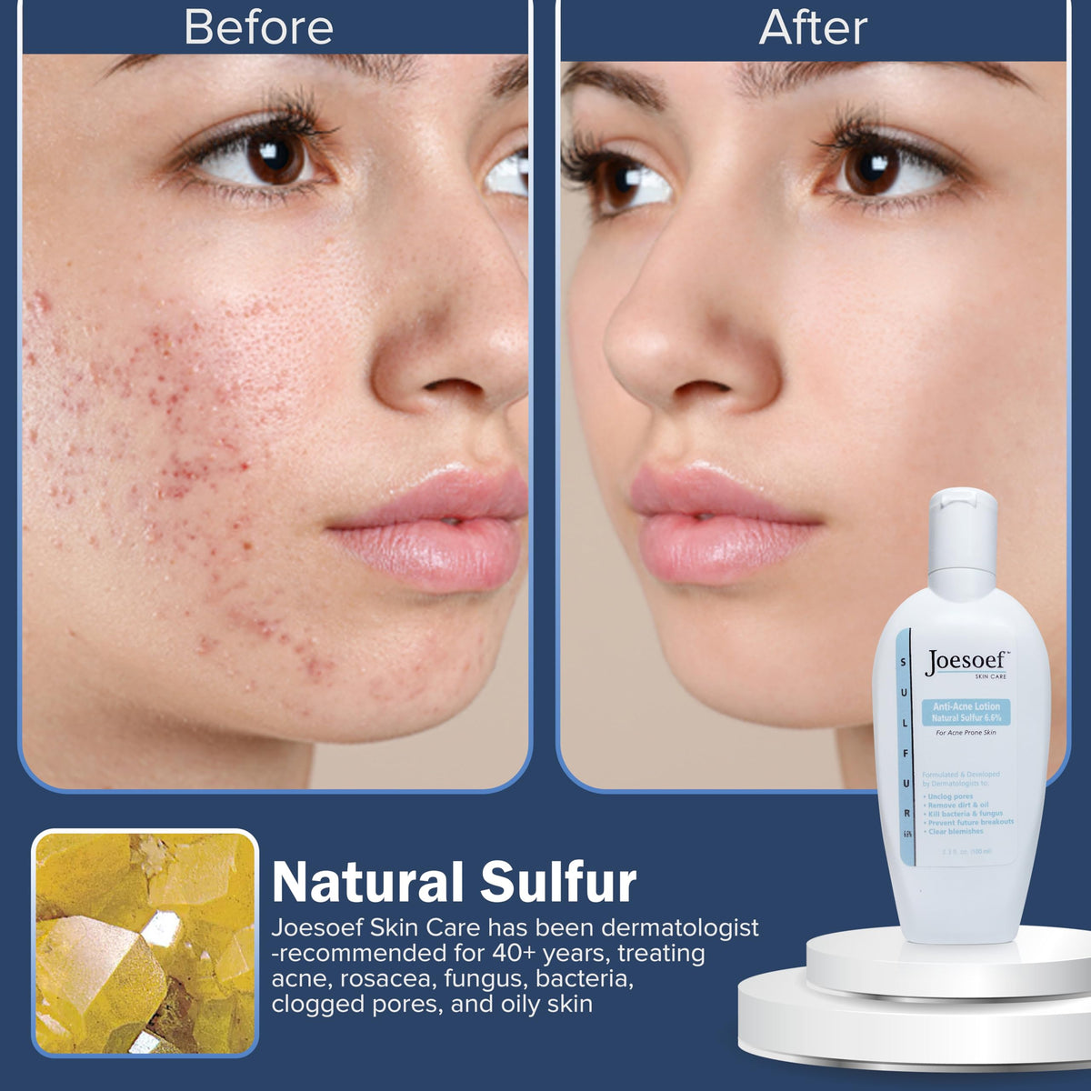 JOESOEF lotion being dispensed for precise spot treatment benefit