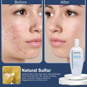 JOESOEF lotion being dispensed for precise spot treatment benefit