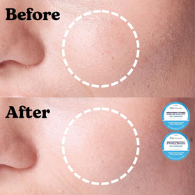 Jung Beauty visible microbubbling CO2 effect on skin demonstrating deep pore action