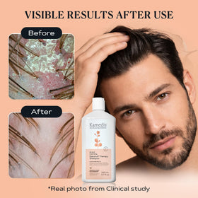 KAMEDIS shampoo being applied to wet hair to soothe scalp
