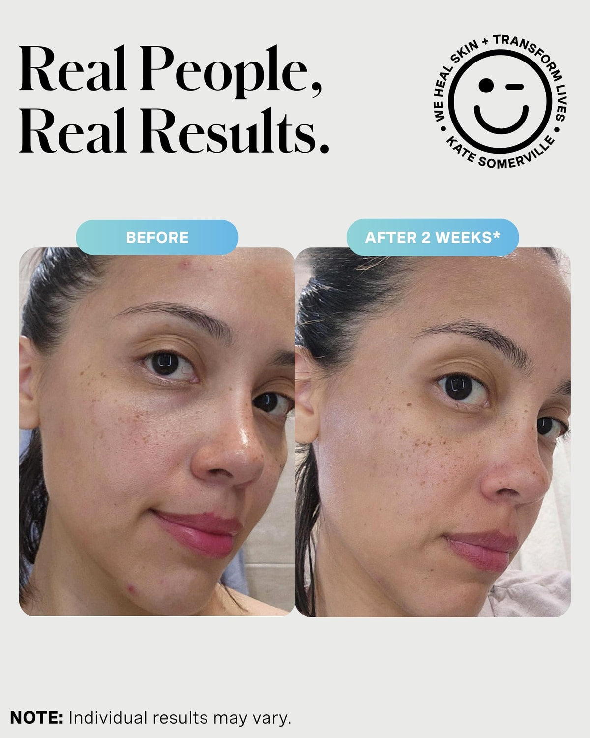 Kate Somerville mask applied to cheek showing targeted breakout treatment