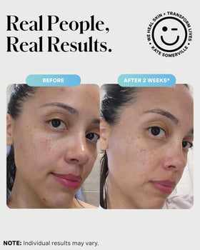 Kate Somerville mask applied to cheek showing targeted breakout treatment