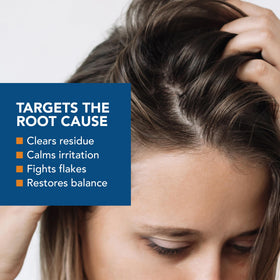 Kenkoderm applying conditioner to scalp to help lift flakes