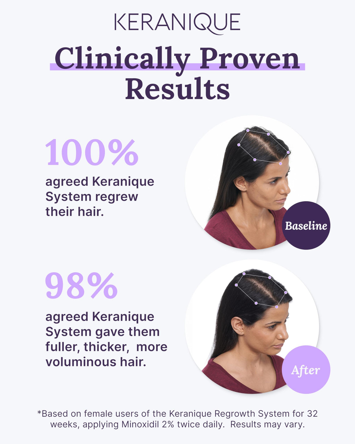 Keranique application on scalp demonstrating precise targeted use