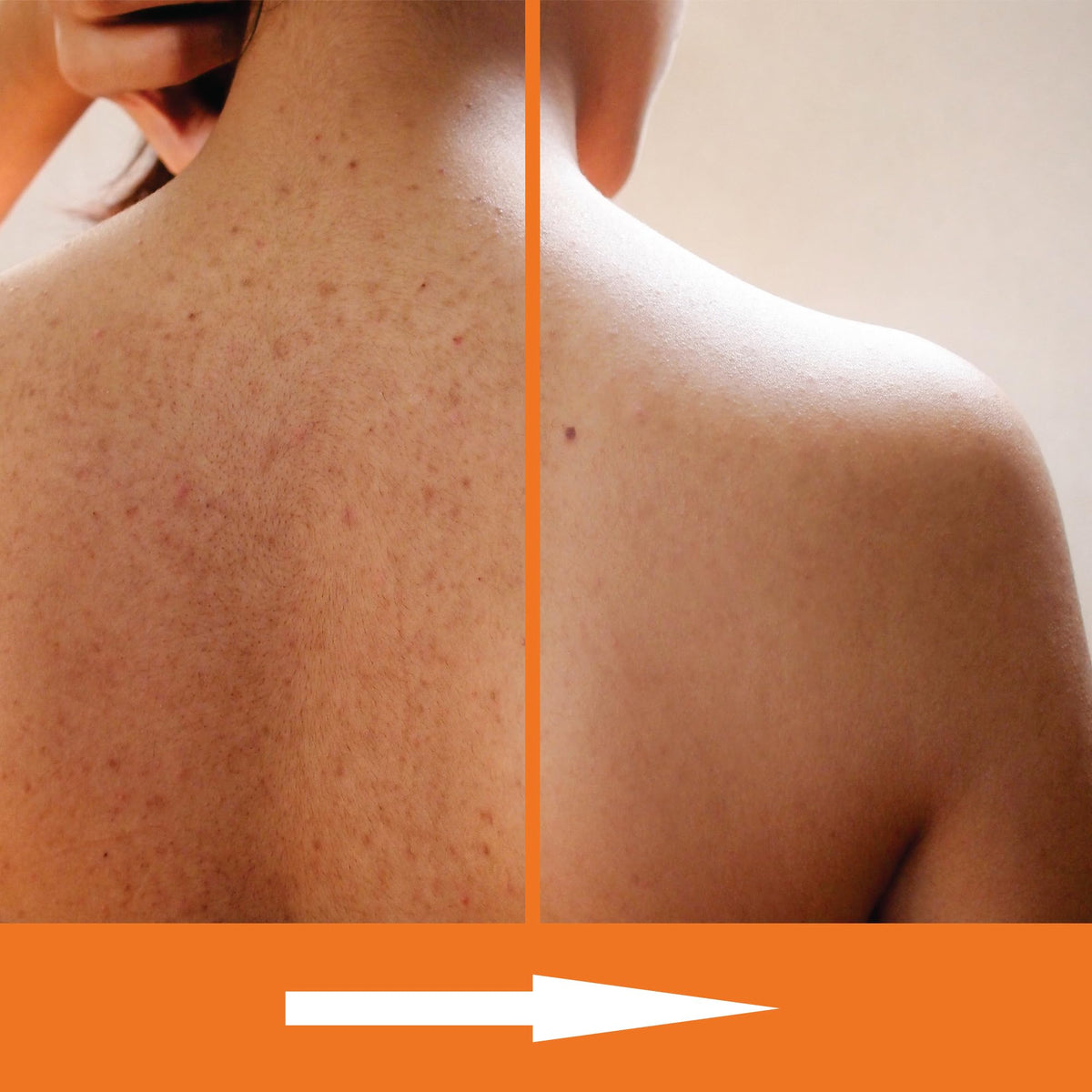 KERAPIL label close-up highlighting salicylic acid lactic acid and ceramides benefits