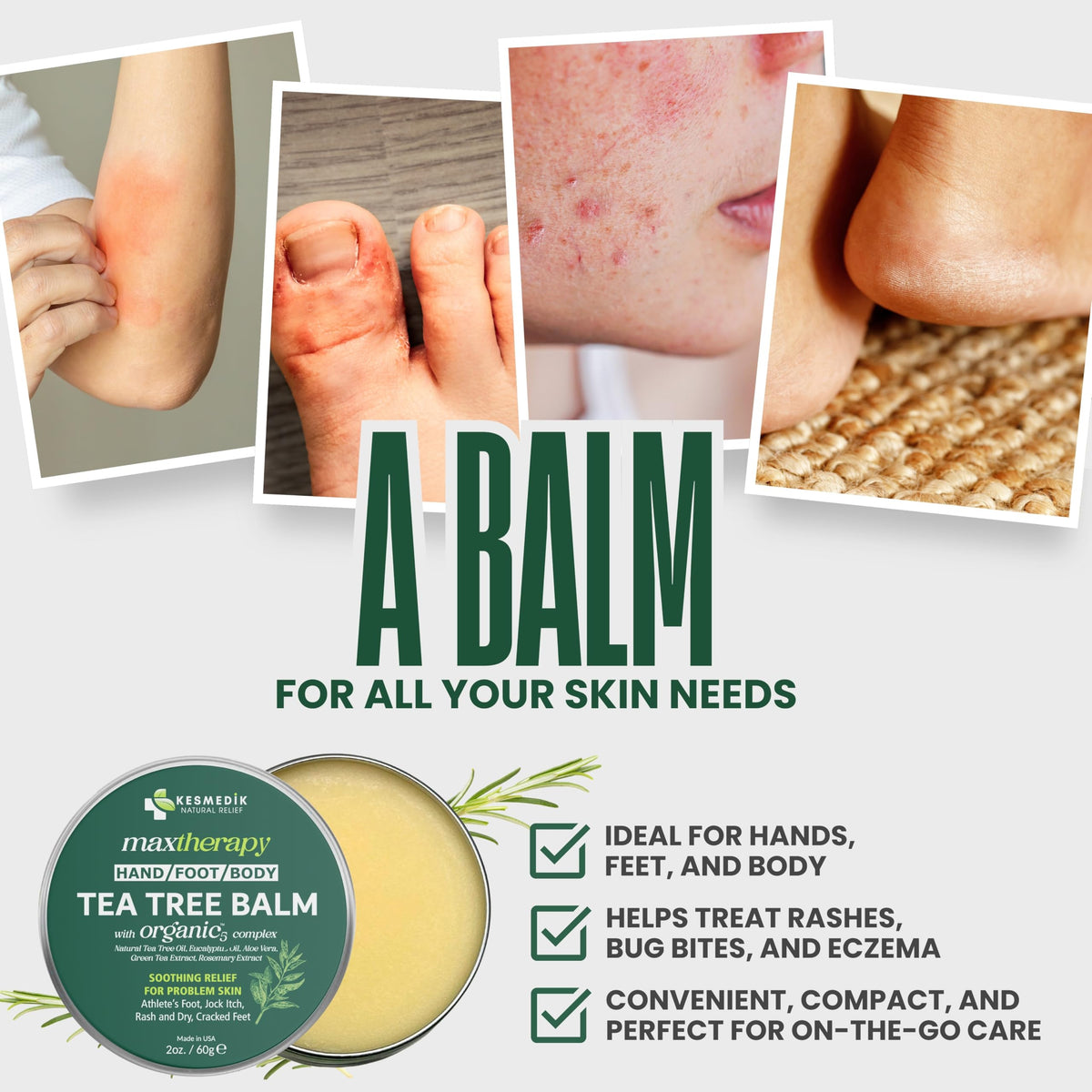 KESMEDIK balm being applied to foot to soothe itching