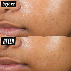 Kiehl's application demo on cheek showing targeted spot treatment