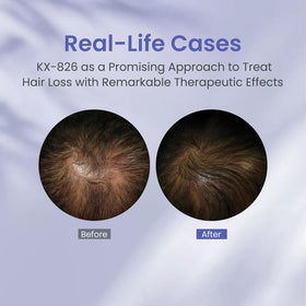 KINTOR before and after hairline comparison illustrating thicker-looking hair benefit