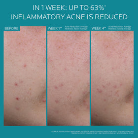 La Roche-Posay Effaclar BPO before and after skin texture showing clearer pores