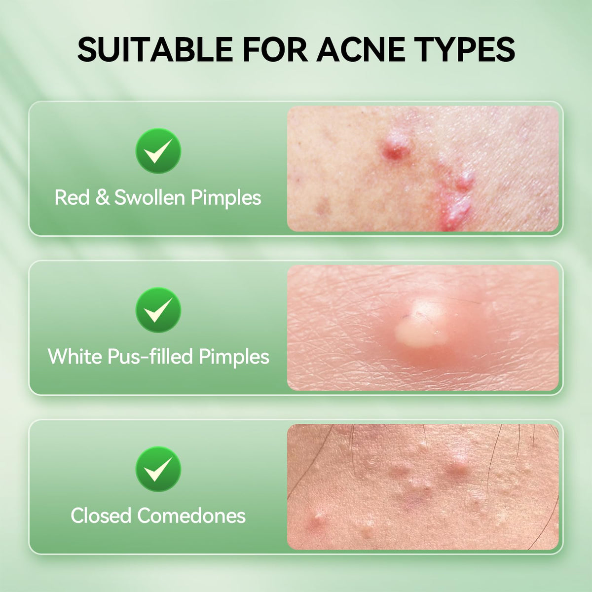LANBENA close-up label highlighting 2% salicylic acid and niacinamide benefits